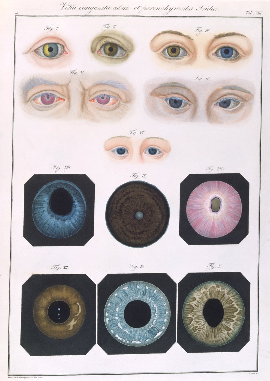 Beskrivelse av medfødte øyeanomalier, fra kliniske presentasjoner av sykdommer og visuelle defekter i det menneskelige øyet, av Friedrich August von Ammon (1799-1861) 1838 av German School