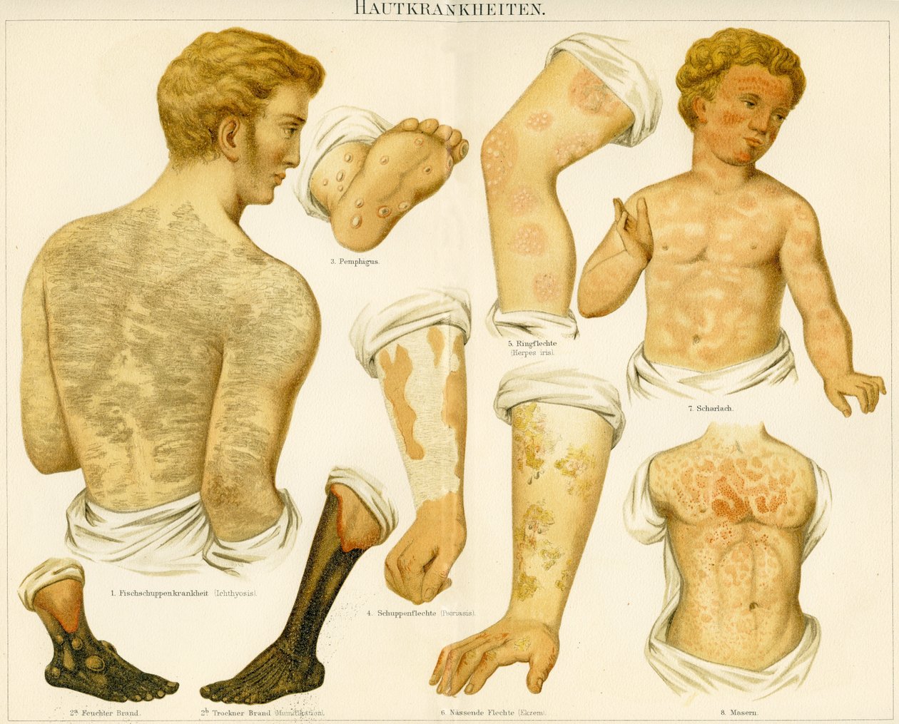 Hudlidelser, ca. 1890 av German School