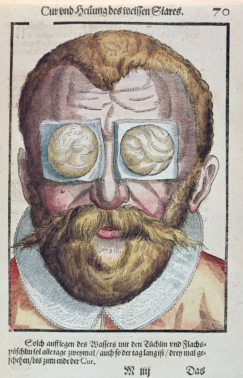 Behandling av en øyelidelse, fra Ophthalmodouleia av Georg Bartisch (1535-1636) utgitt i Dresden i 1583 (farget treblokktrykk) av German School
