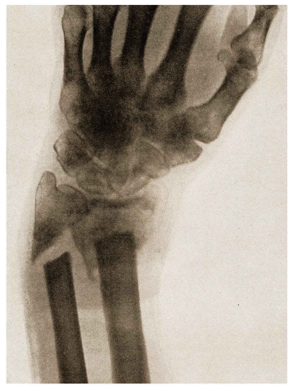 Røntgen av et brukket håndledd ca. 1890 av German School