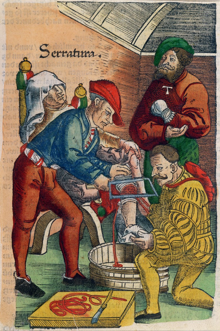 An Amputation, illustrasjon fra 