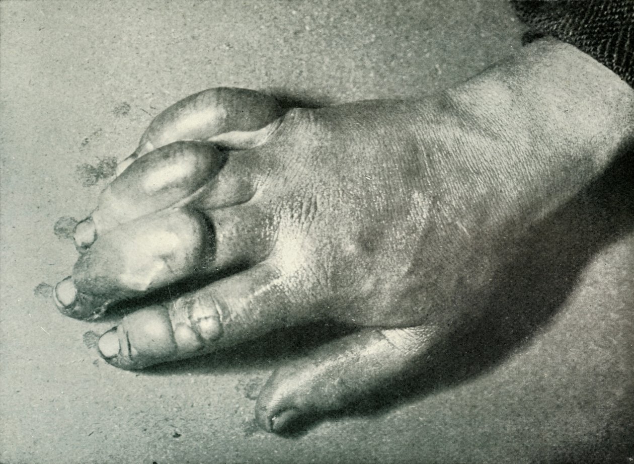 Dr. Atkinsons Frost-Bitten Hand, 5. juli 1911, 1913 av Herbert Ponting