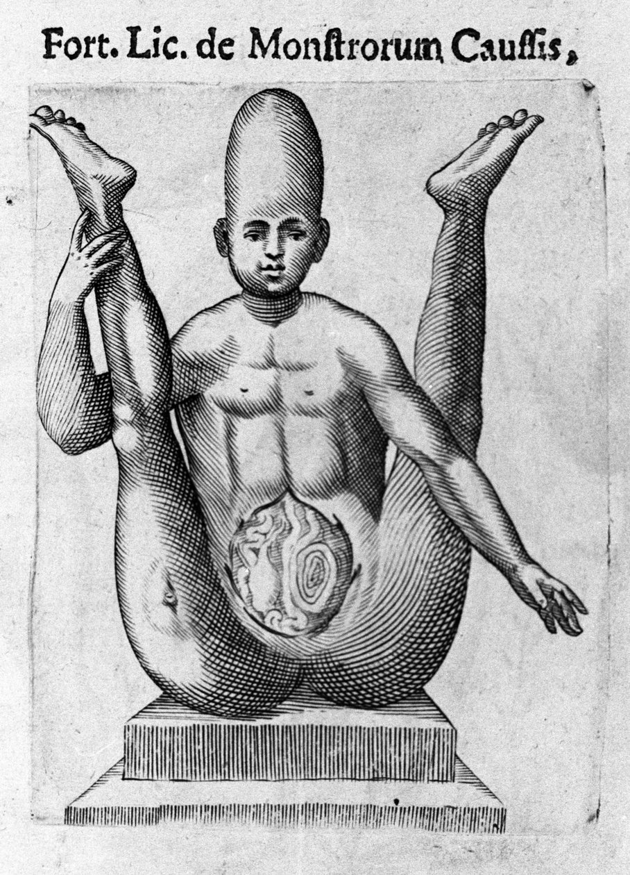 Menneskelig monster: en skapning med en enorm hodeskalle, med tydelige tarmer. Gravering fra "Monstrenes natur, deres årsaker og forskjeller" av Fortunio Selvomi (1577-1656), italiensk vitenskapsmann. 1646 av Italian School