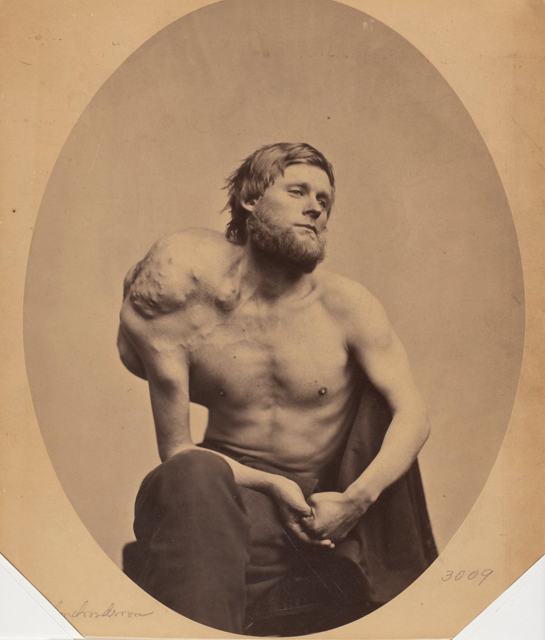 Enchondroma av scapula av James Wallace Black