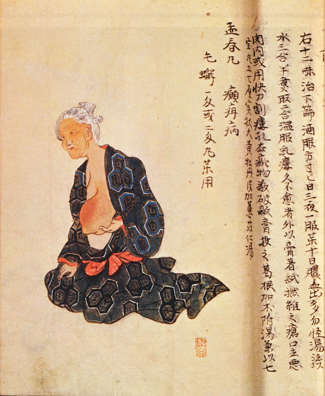 Den første kirurgiske behandlingen av brystkreft utført under generell anestesi av Seishu Hanaoka (1760-1836) i 1804 av Japanese School