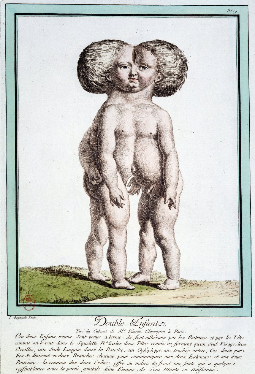 Siamesiske barn - i "" Naturens avvik"" av Régnault av Jean Baptiste Regnault