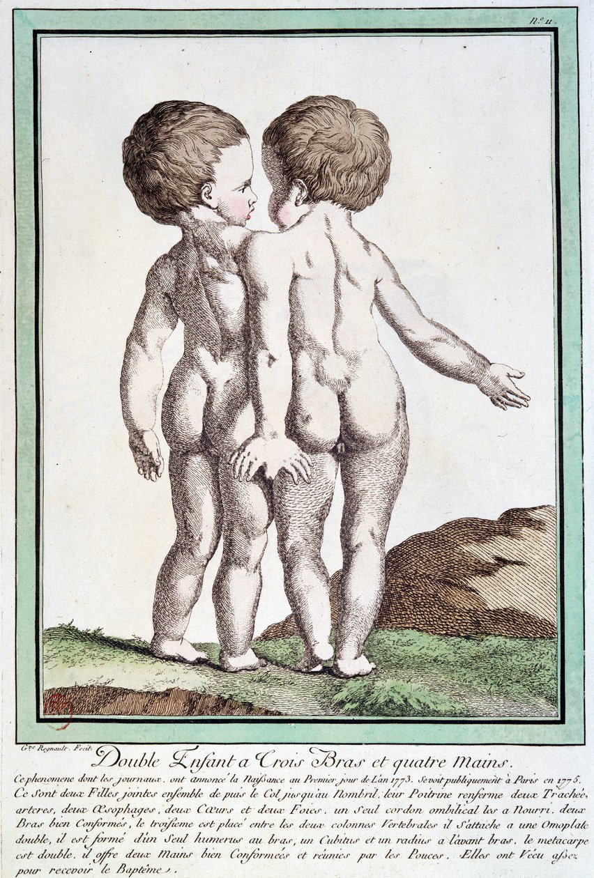 Siamesiske barn - i "" Naturens avvik"" av Régnault av Jean Baptiste Regnault