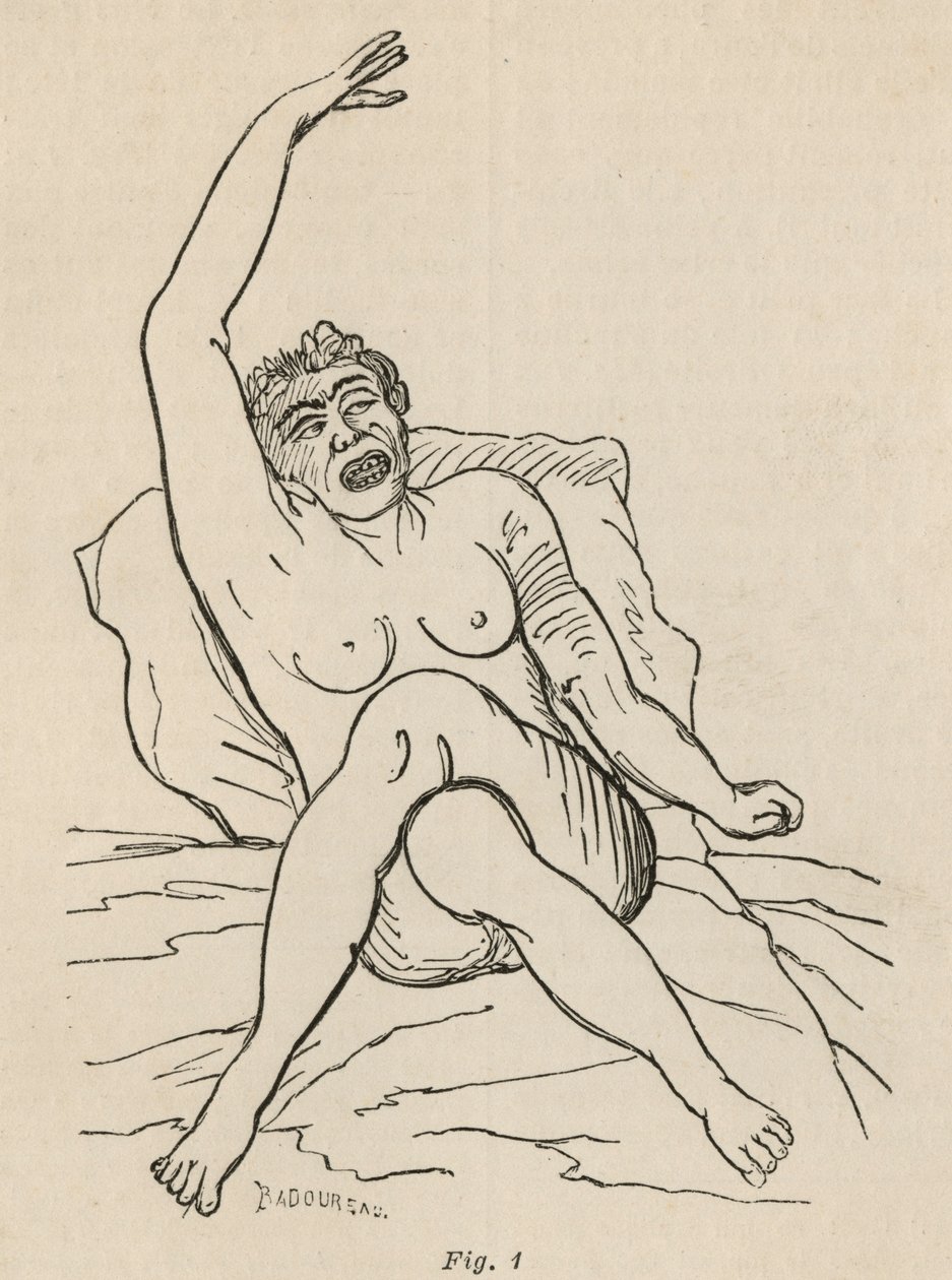 Hysterisk epilepsi, angrep, vridninger, fig. 1 fra 