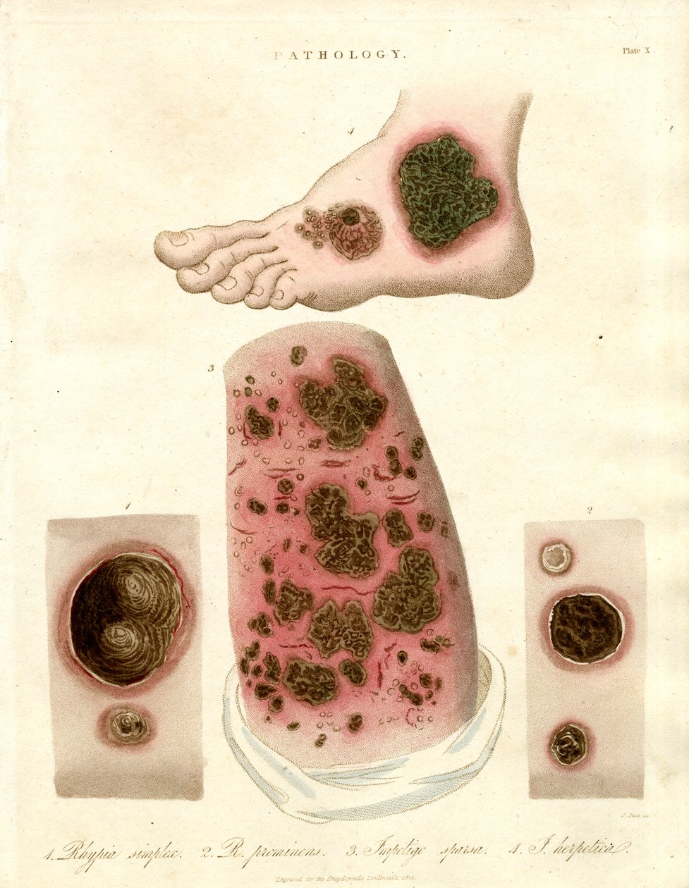 Patologiske hudsykdommer - Pityria, impetigo og syfilis av John Pass