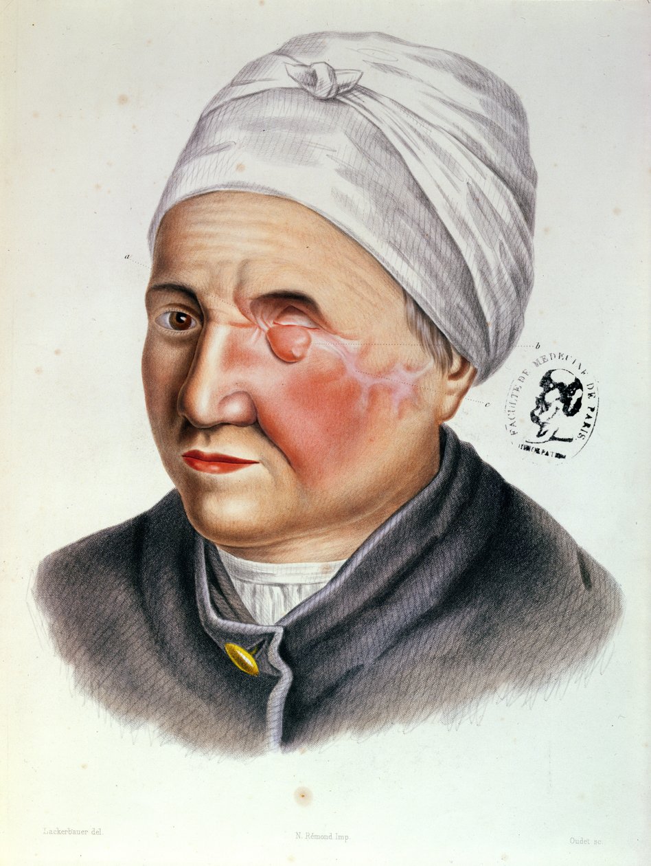 Illustrasjon fra Traite de Chirurgie Plastique av Antoine Jobert de Lamballe (1799-1867) Paris, 1849 av Lackerbauer
