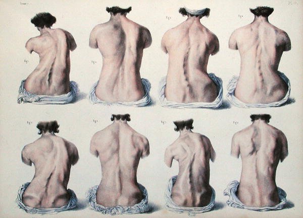 Spinal deformiteter, plate fra 
