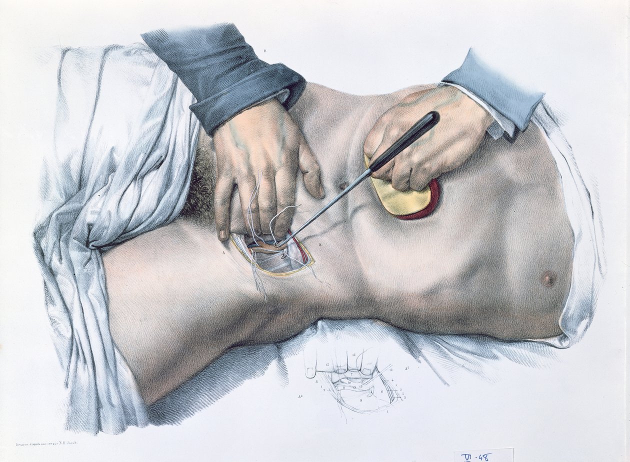 Fester en arterie, tallerken fra 