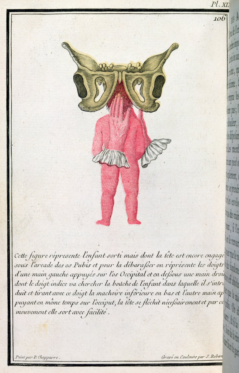 Tverrsnittsdiagram av en baby trukket fra livmoren, fra en bok av Madame Angelique Le Boursier du Coudray (1714-94) gravert av J. Robert, 1783 av P. Chapparre