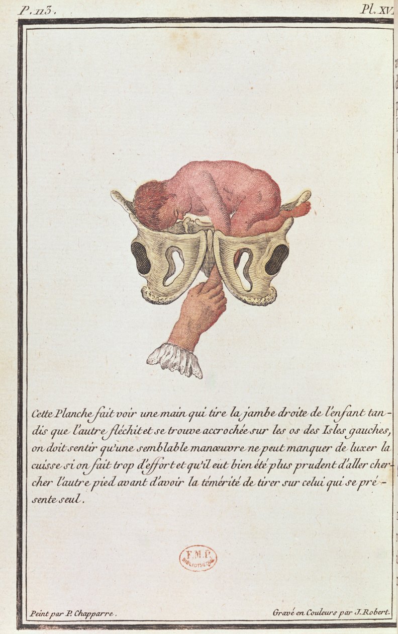 Tverrsnittsdiagram av en baby trukket fra livmoren av armen, fra en bok av Madame Angelique Le Boursier du Coudray (1714-94) gravert av J. Robert, 1783 av P. Chapparre