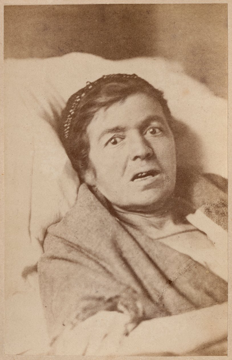Hysterisk epilepsi, ansiktskontraksjon, plate VIII fra 'Iconographie Photographique de La Salpetriere' av Bourneville og P. Regnard, Paris, 1876 (albumtrykk) av Paul Regnard