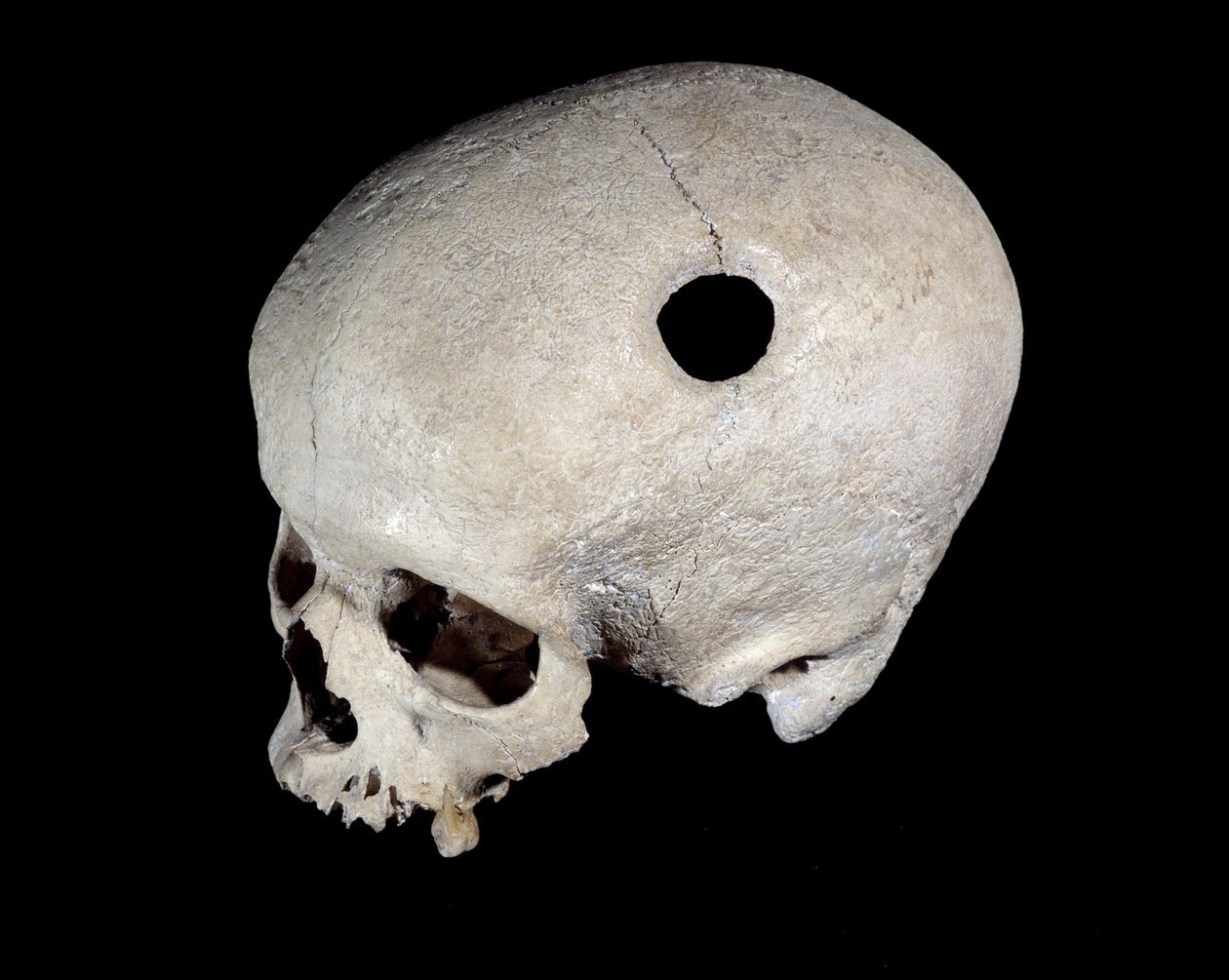 Forhistorisk hodeskalle med trepanasjonsspor, Museum of National Antiquities. av Prehistoric Prehistoric