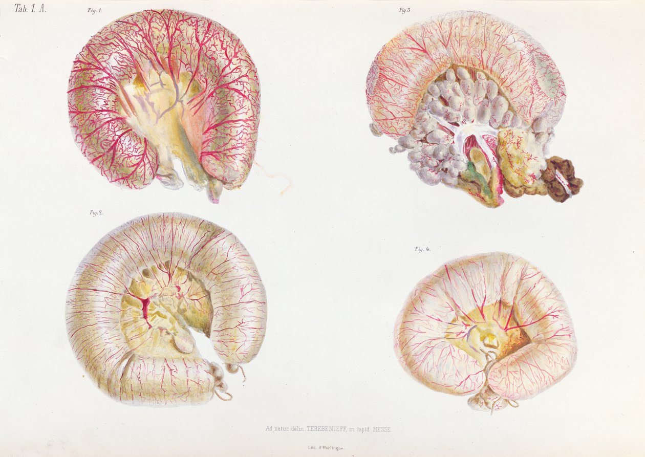 Den ytre overflaten av tarmene infisert med kolera, fra Anatomie Pathologique du Cholera Morbus, av Nikolai Ivanovich Pirogov (1810-81) publisert i St. Petersburg, 1849 av Russian School