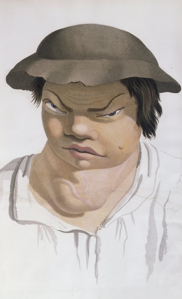 Endemic Scrofula, illustrasjon fra en bok av Baron Jean Louis Alibert (1768-1837) av Salvadore Tresca