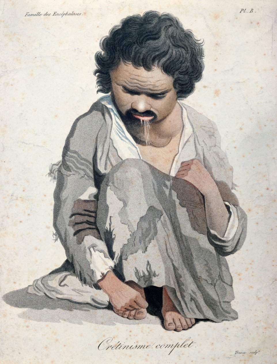 Total kretinisme, fra en bok av Baron Jean Louis Alibert (1768-1837) av Salvadore Tresca