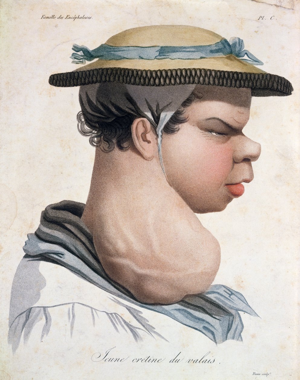 Young Cretin fra Valais, illustrasjon fra en bok av Baron Jean Louis Alibert (1768-1837) av Salvadore Tresca