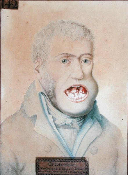 Osteosarkom i underkjeven, operert med suksess av Guillaume Dupuytren (1777-1835) (blyant på papir) av School French