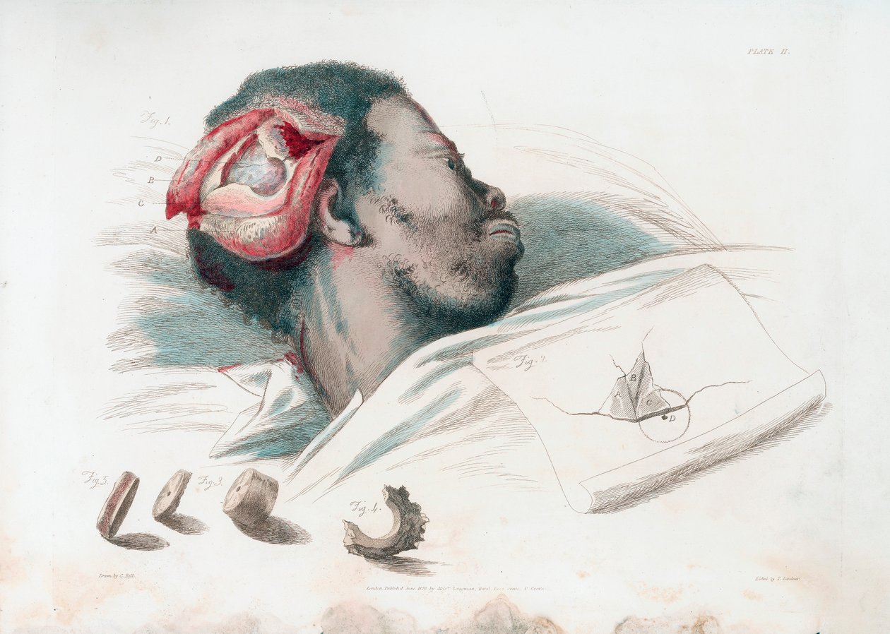 Visning av sår i hodeskallen etter trephination og fjerning av knust benstykke nederst til venstre, 1821 av Thomas Landseer
