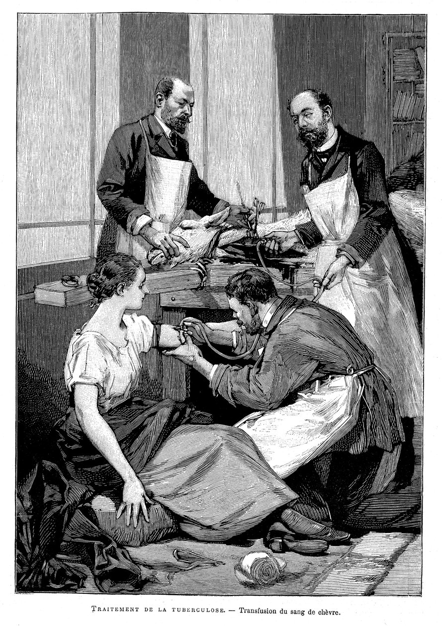 En tuberkulosepasient som ble gitt en transfusjon av geiteblod, 1891 av Unbekannt