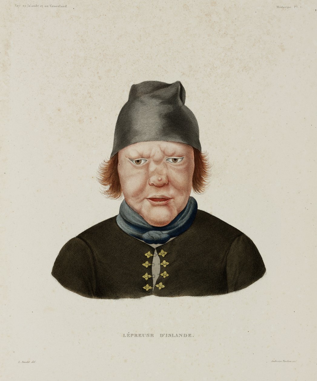 Sykdommer, spedalskhet Spedalsk kvinne, Island, tidlig på 1800-tallet av Unbekannt