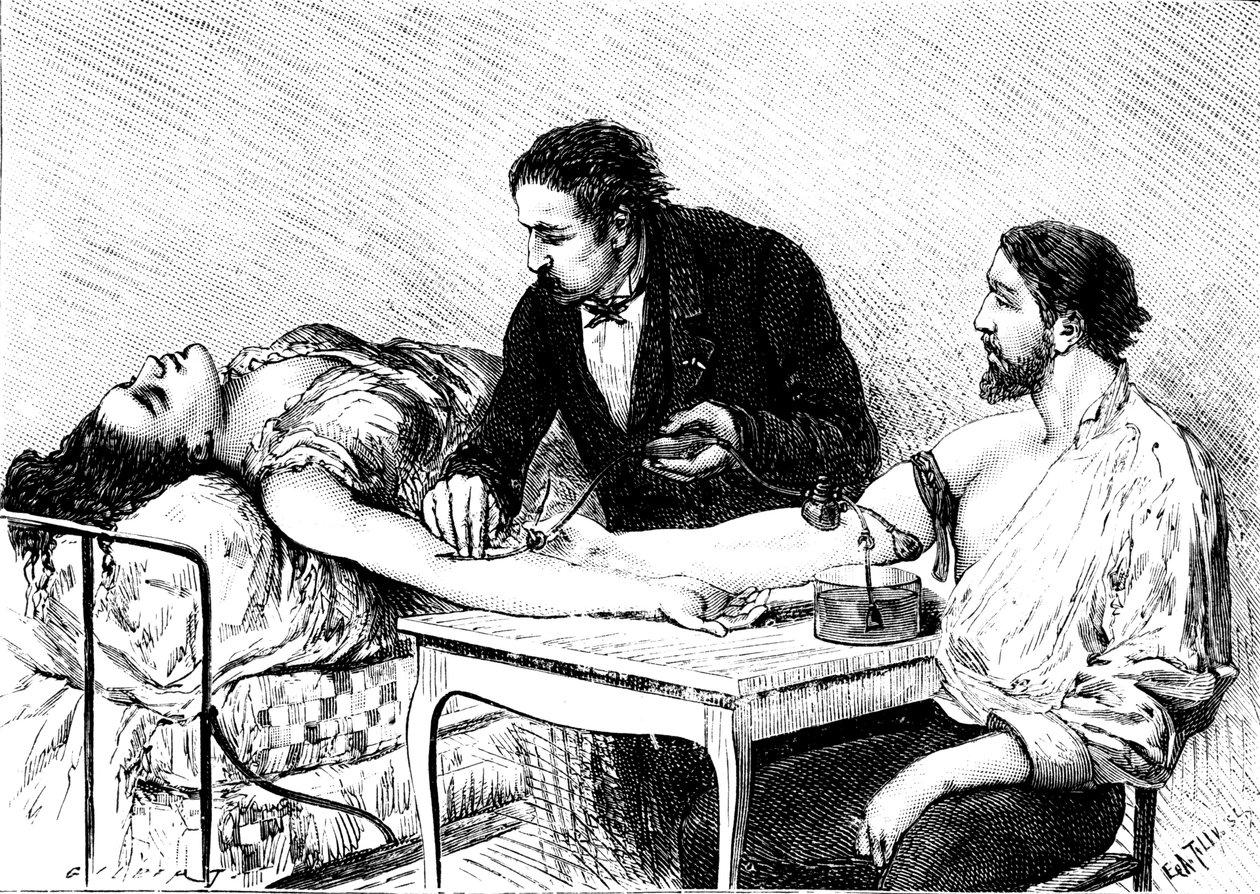 Dr Roussell fra Genève ga en kvinne en direkte blodoverføring fra en frivillig, 1882 av Unbekannt