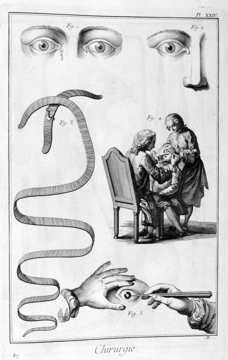 Øyekirurgi, 1751-1777 av Unbekannt