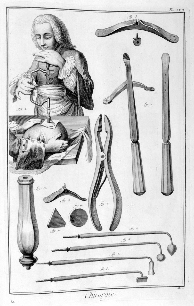 Hodekirurgi, 1751-1777 av Unbekannt