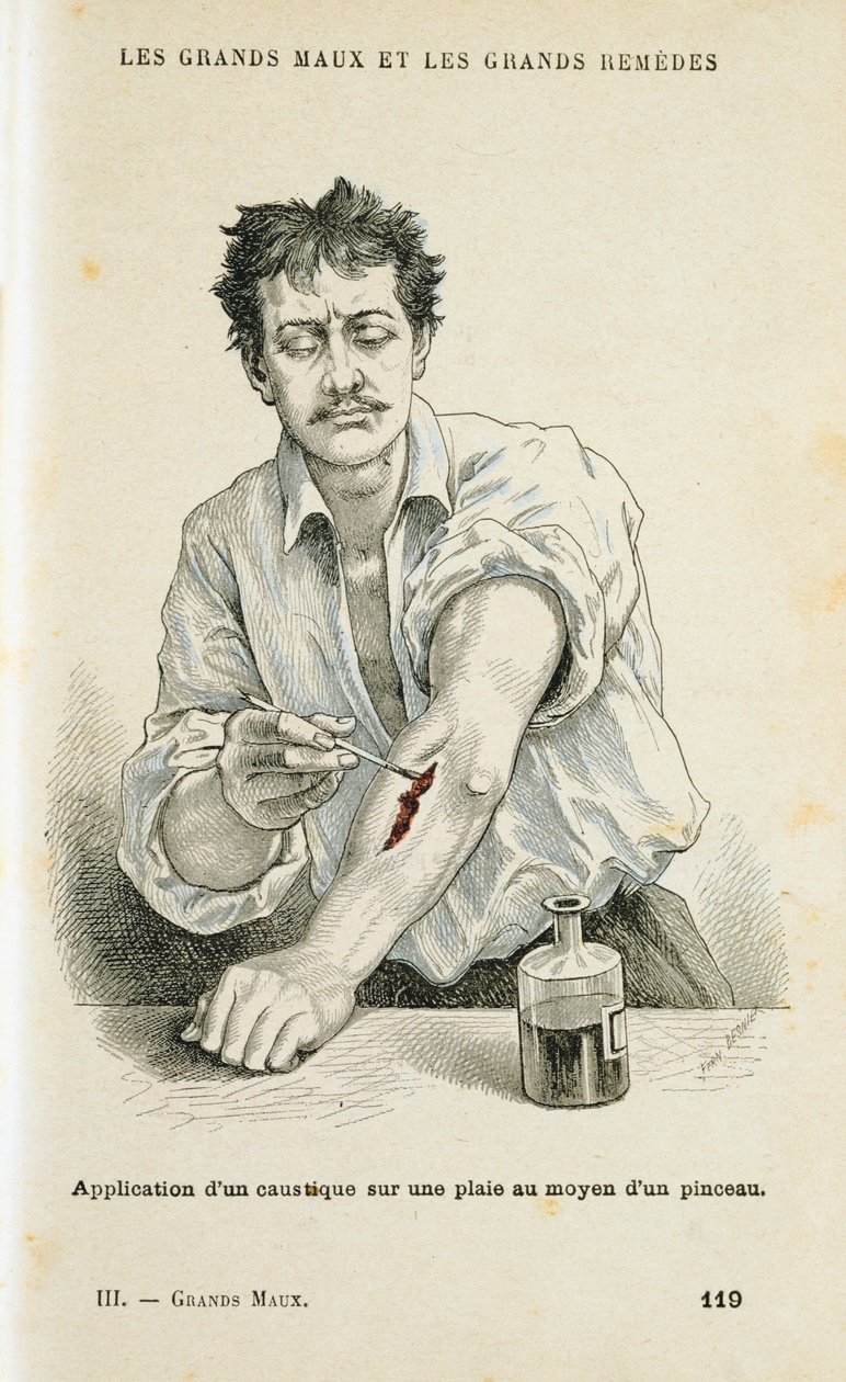 Male et sår med en antiseptisk løsning, c1890 av Unbekannt