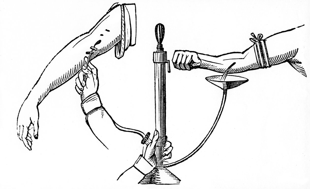 Person-til-person blodoverføring, 1833 av Unbekannt