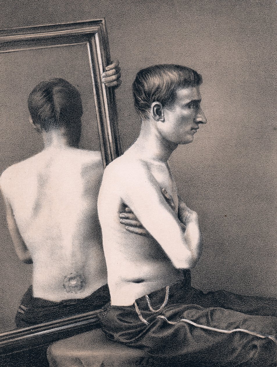 Gjenoppretting av et skuddskade i magen, amerikansk borgerkrig, 1865 av Unbekannt