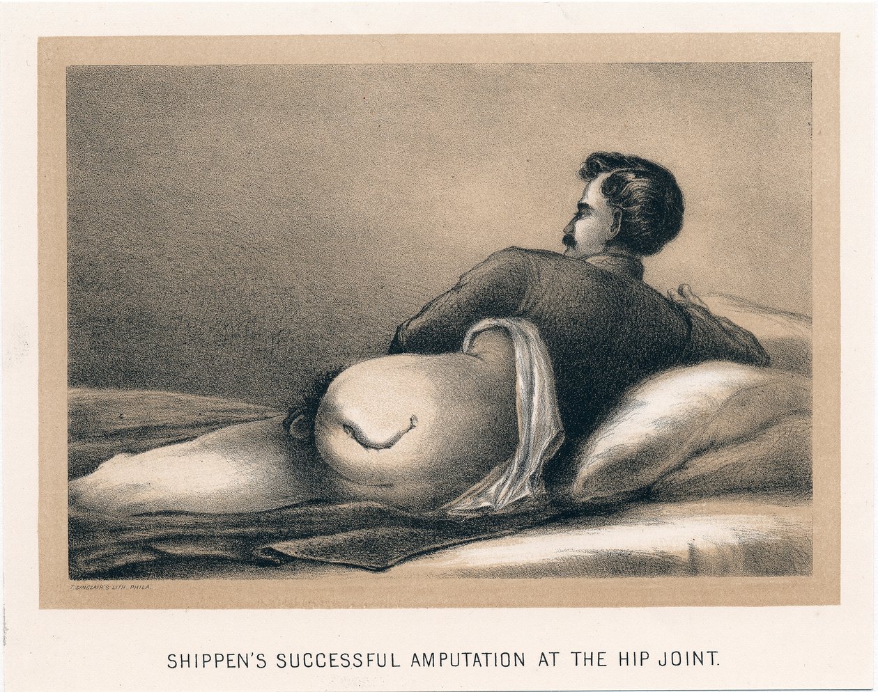 Sender vellykket amputasjon ved hofteleddet, amerikansk borgerkrig, 1865 av Unbekannt