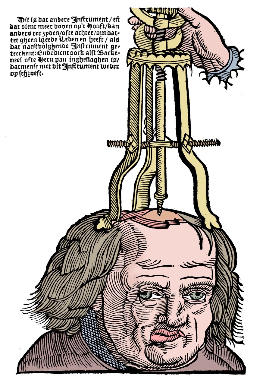 Trephination, 1593 av Unbekannt