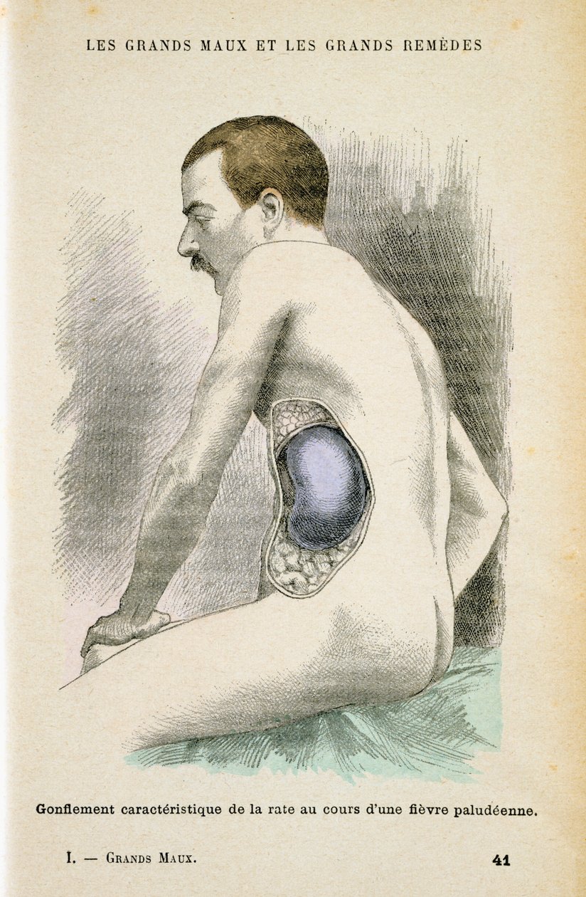 Typisk forstørret milt hos en malariapasient, c1890 av Unbekannt