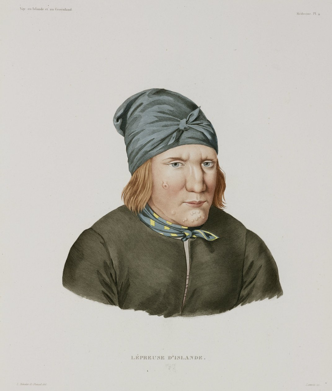 Sykdommer, spedalskhet Spedalsk kvinne, Island, tidlig på 1800-tallet av Unbekannt