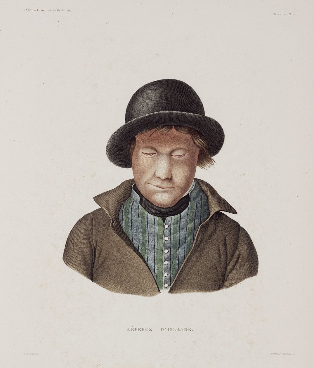 Sykdommer, spedalskhet Spedalsk mann, Island, tidlig på 1800-tallet av Unbekannt