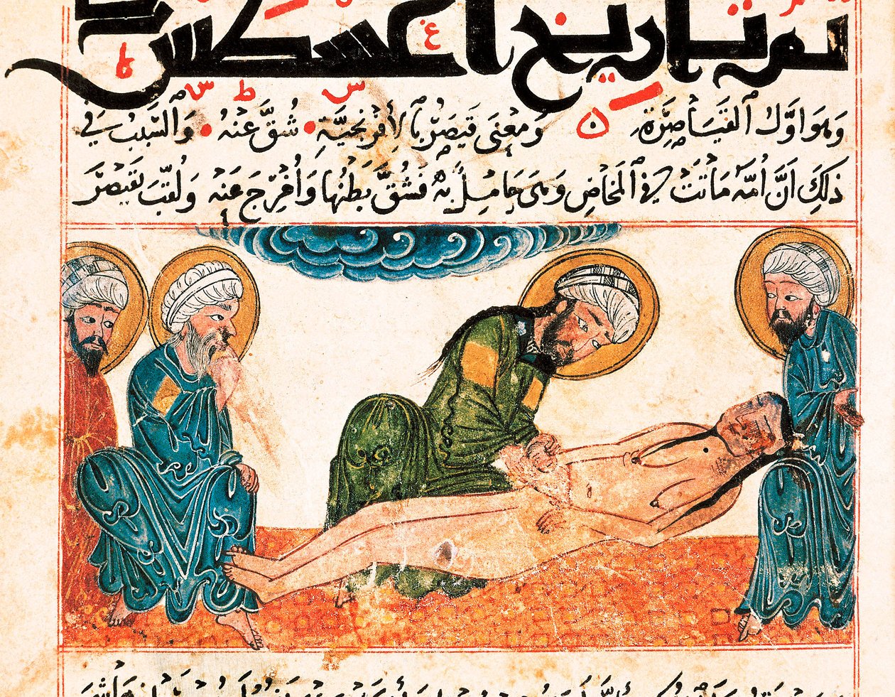 Representasjon av keisersnitt. Miniatyr hentet fra et medisinmanuskript av Abu Raihan Al-Biruni (eller Alberuni) (973-1048), persisk intellektuell og vitenskapsmann, folio 161. av Unbekannt