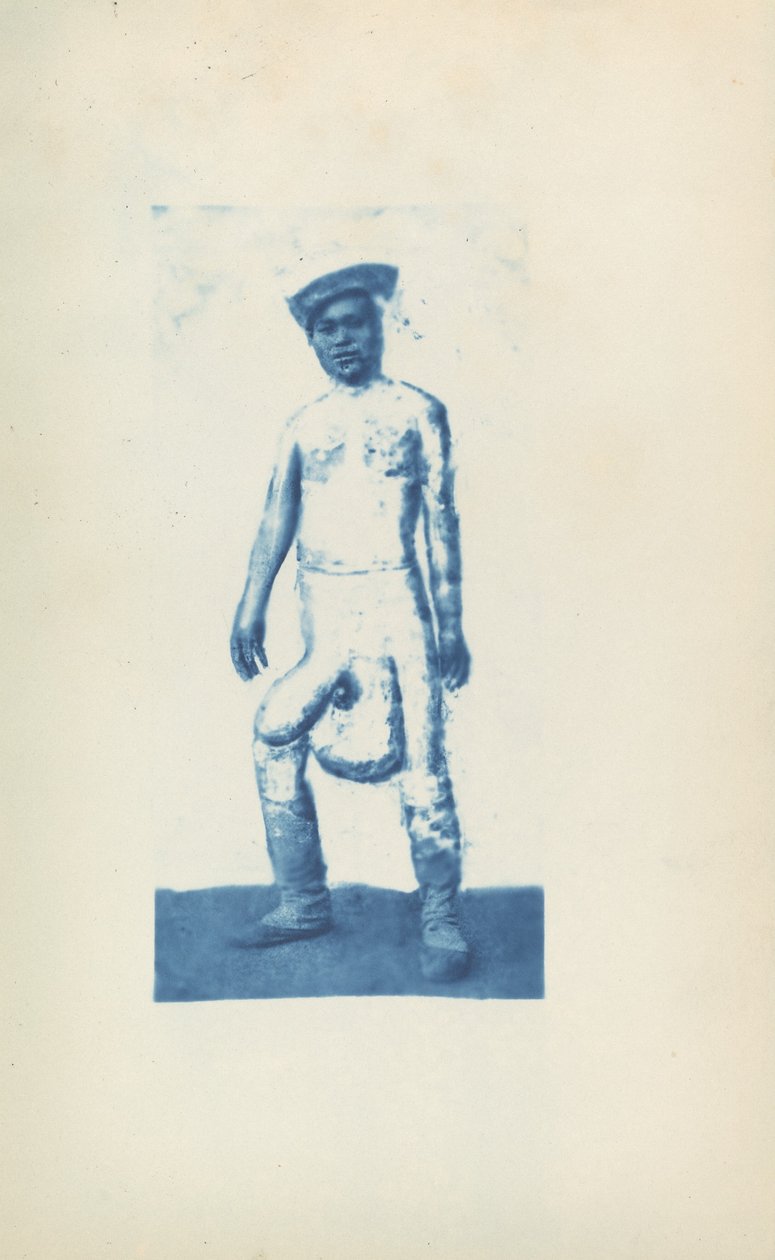 Elefantiasis av Unknown 19th Century
