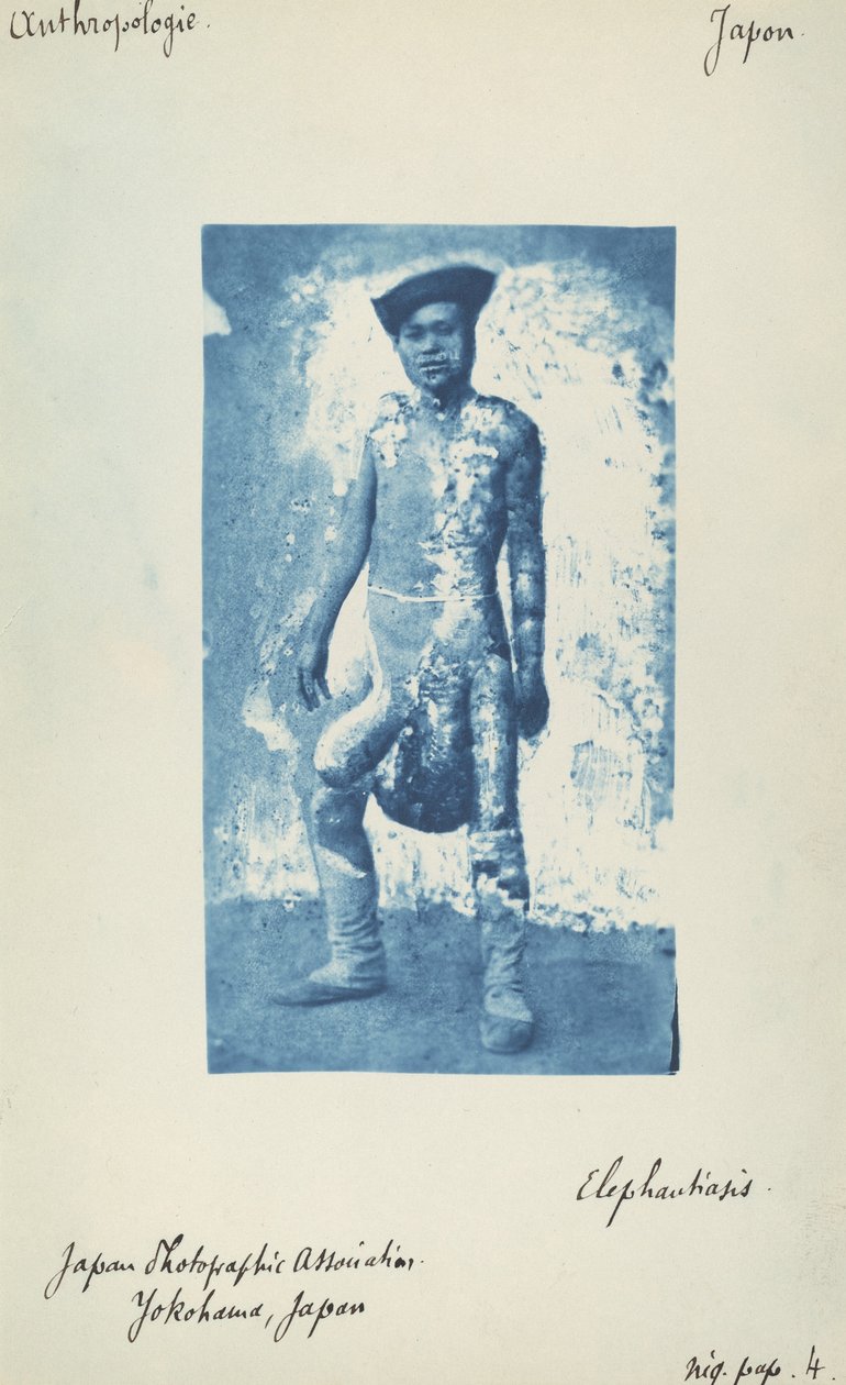 Elefantiasis av Unknown 19th Century