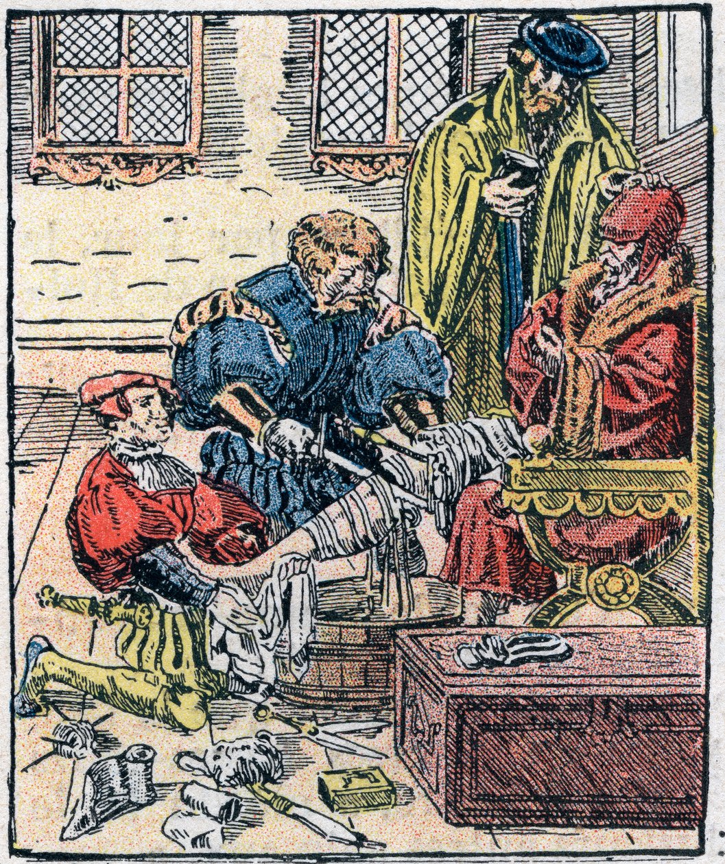 Amputasjon av et ben på 1500-tallet. av Unknown artist
