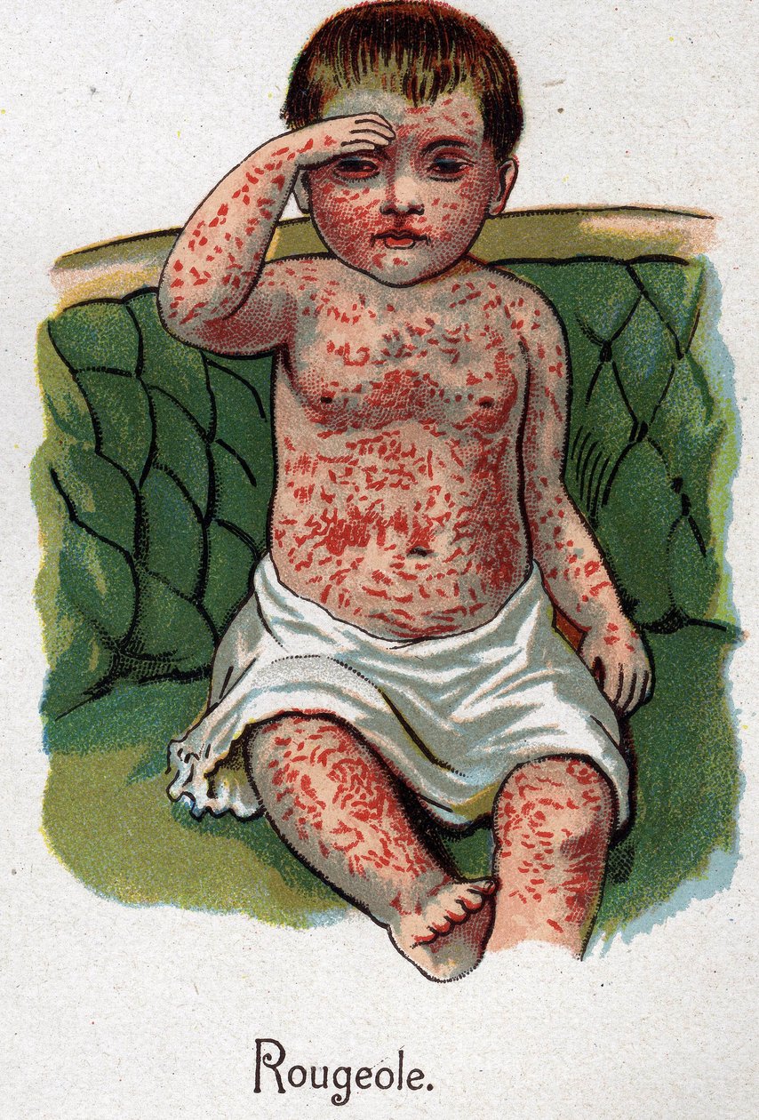 Barnesykdommer: Meslinger. I "Den nye naturmedisinen"" av F.E. Bilz. av Unknown artist