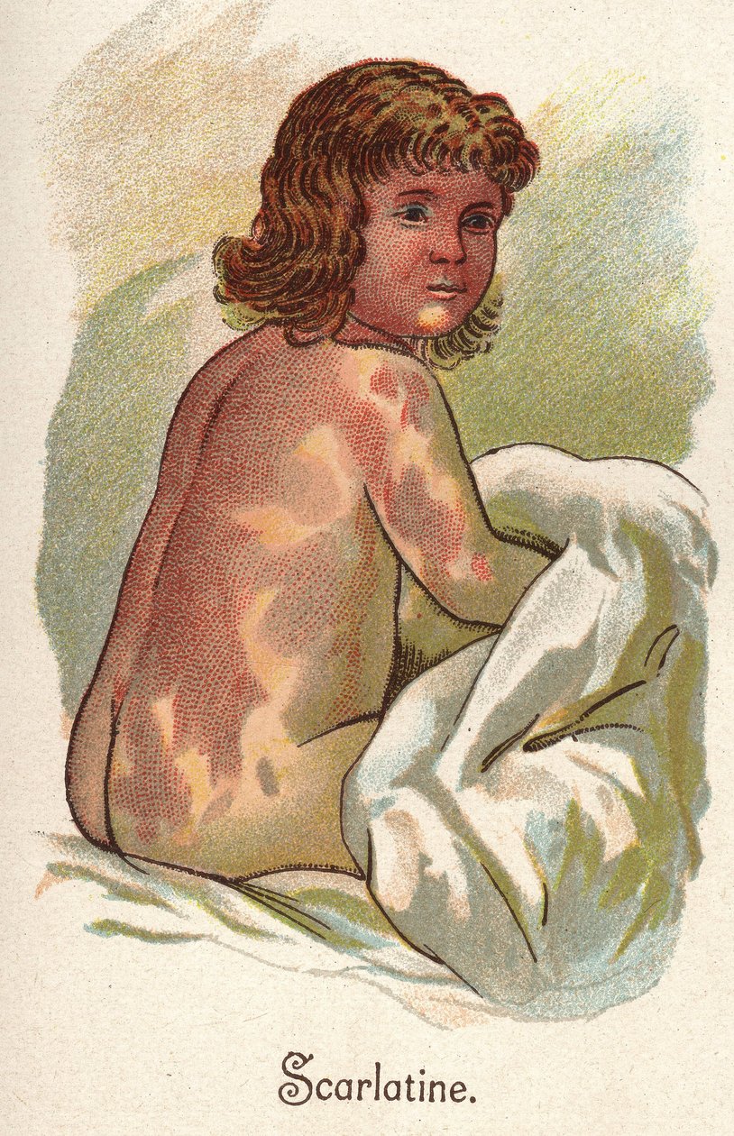 Barnesykdommer: Skarlagensfeber. I "Den nye naturlige medisinen"" av F.E. Bilz. av Unknown artist