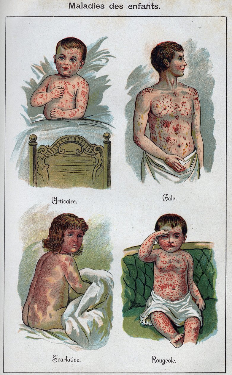 Diseases of children: Hives, Measles, scabies, scarlet fever. In” The new natural medication”” by F.E. Bilz. av Unknown artist
