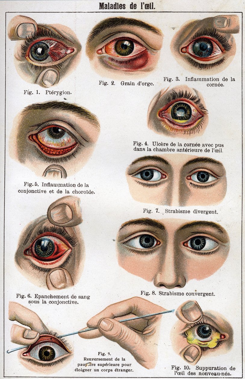 Diseases of the Eye. “The new natural medicine” by F.E. Bilz. av Unknown artist