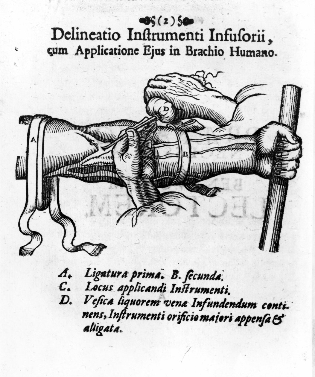 Intravenøs injeksjon ved hjelp av en clystery blære. av JD Mayor, "" Surgery Infusoria "", Kilonii 1667 av Unknown artist