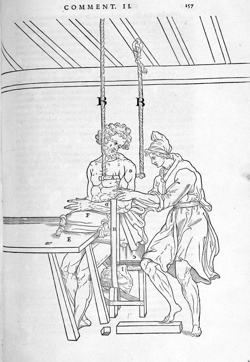 Reduksjon av brudd. Plate illustrert av "Disseksjonen av menneskekroppen i tre deler..." av Carlo Stefano Riverio, Paris 1545 av Unknown artist