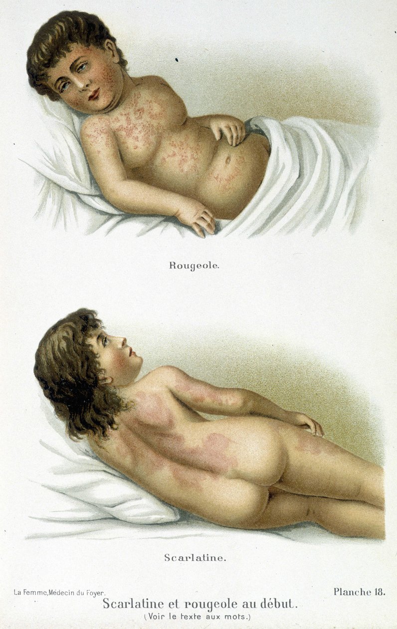 Skarlagensfeber og meslinger - 1800-tallet av Unknown artist
